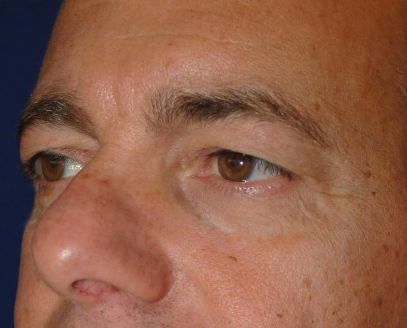 Eyelid Surgery Before & After Gallery - Patient 364560 - Image 5