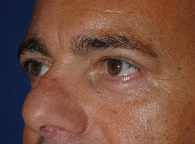 Eyelid Surgery Before & After Gallery - Patient 364560 - Image 6