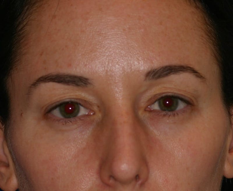 Eyelid Surgery Before & After Gallery - Patient 399000 - Image 1