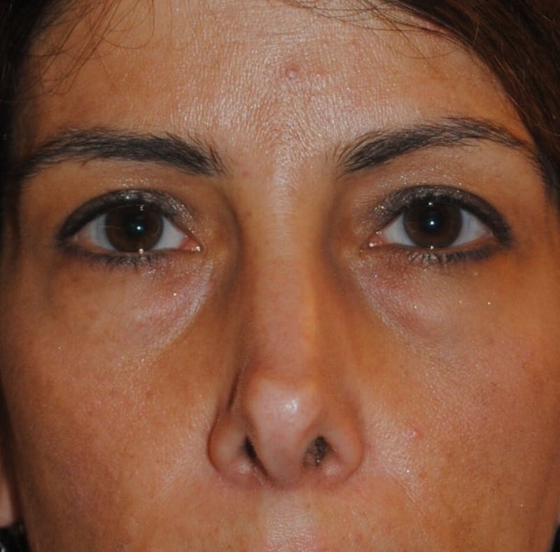 Revision Rhinoplasty Before & After Gallery - Patient 230490 - Image 1