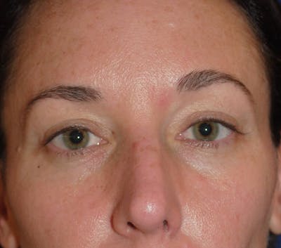 Eyelid Surgery Before & After Gallery - Patient 399000 - Image 2