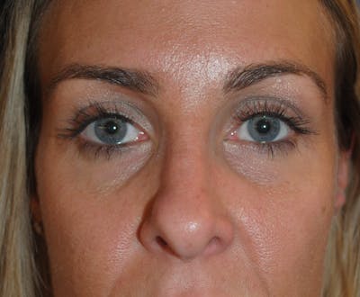 Rhinoplasty Before & After Gallery - Patient 250167 - Image 1