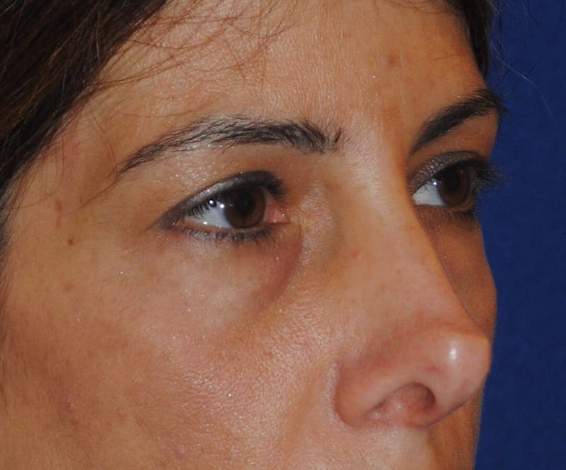 Revision Rhinoplasty Before & After Gallery - Patient 230490 - Image 3