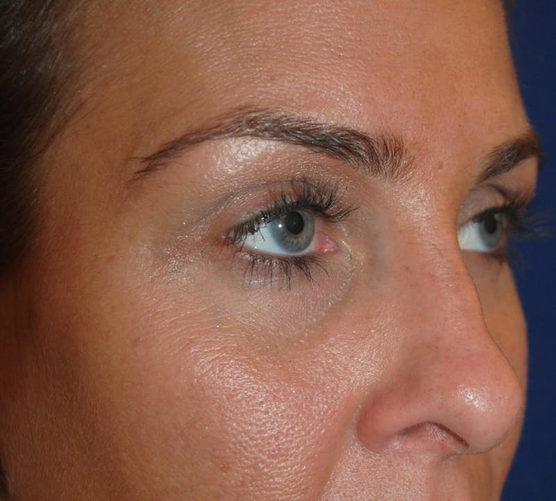 Rhinoplasty Before & After Gallery - Patient 250167 - Image 3