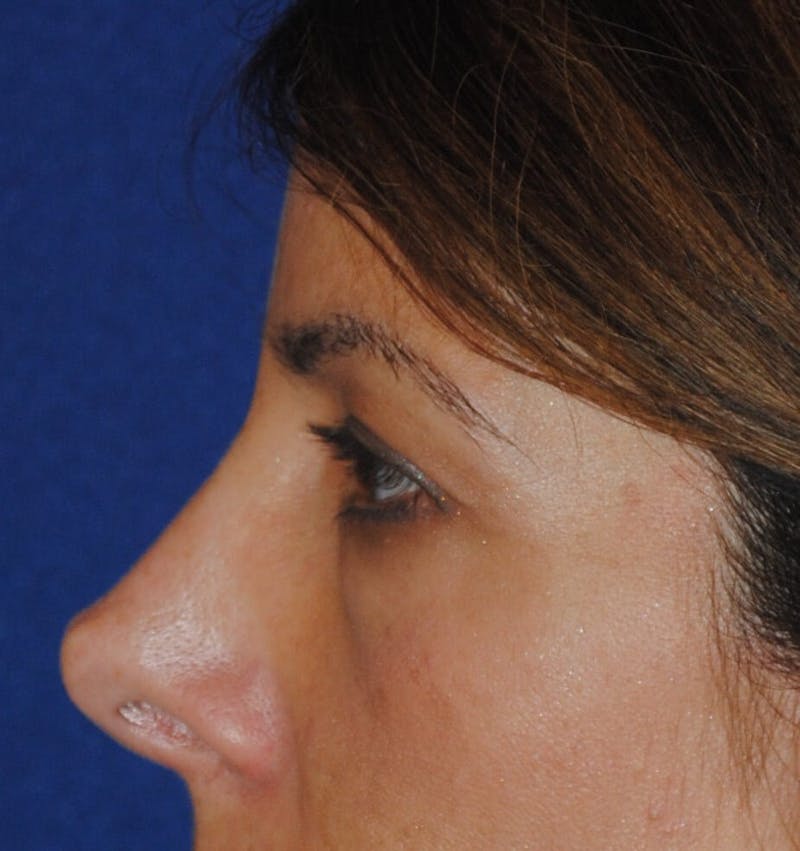 Revision Rhinoplasty Before & After Gallery - Patient 230490 - Image 5