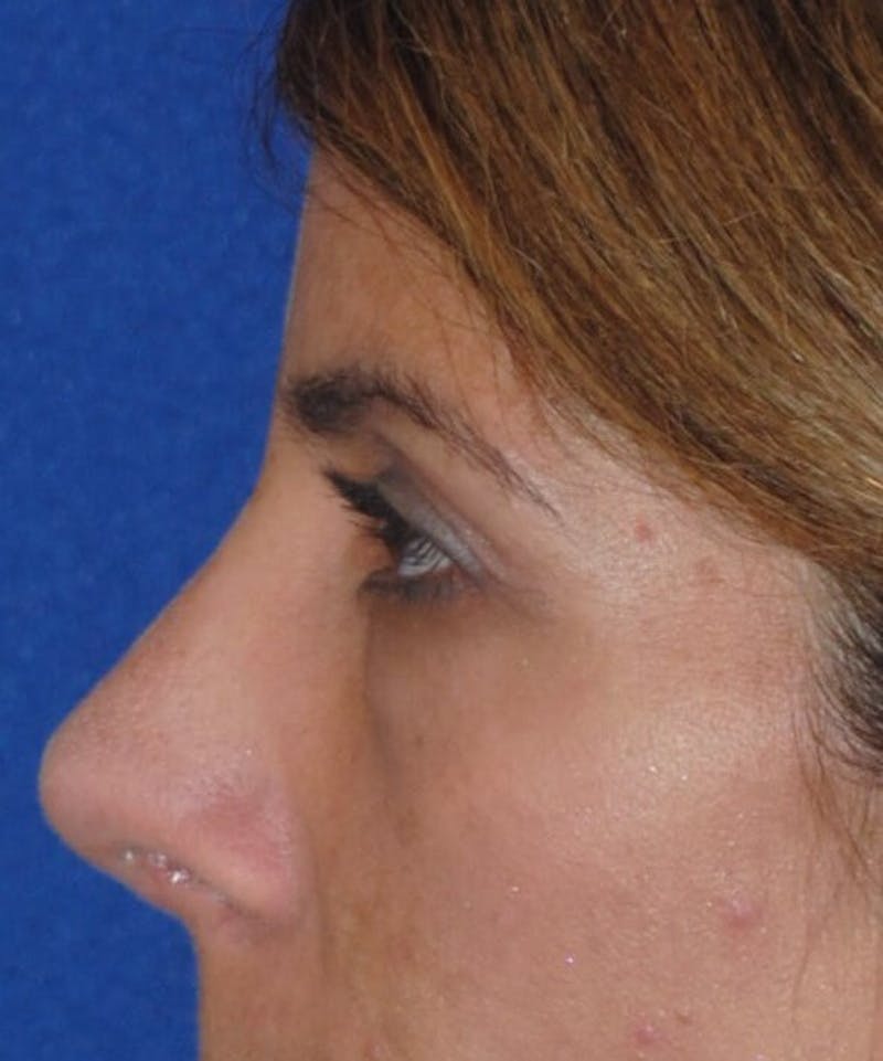 Revision Rhinoplasty Before & After Gallery - Patient 230490 - Image 6