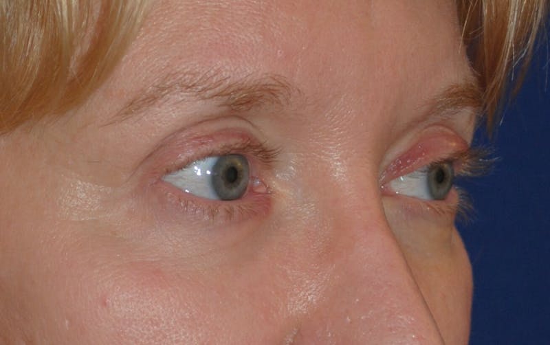 Eyelid Surgery Before & After Gallery - Patient 241341 - Image 1