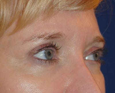 Eyelid Surgery Before & After Gallery - Patient 241341 - Image 2