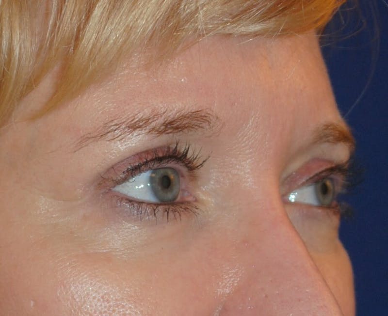 Eyelid Surgery Before & After Gallery - Patient 241341 - Image 2
