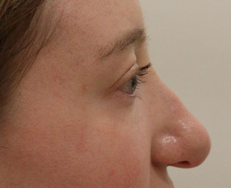 Rhinoplasty Before & After Gallery - Patient 145441 - Image 3