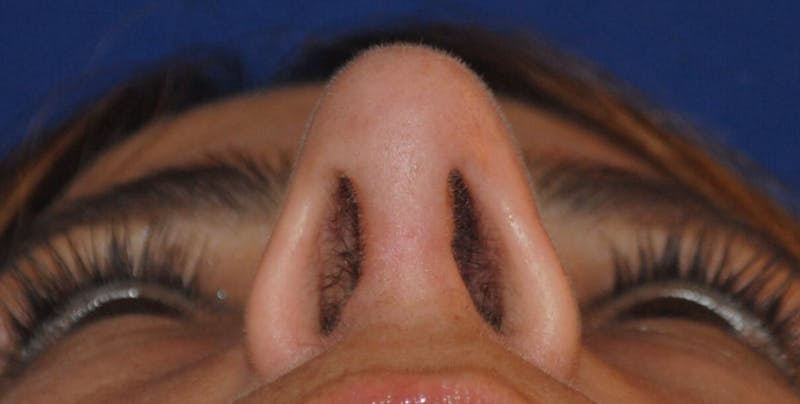 Revision Rhinoplasty Before & After Gallery - Patient 230490 - Image 8
