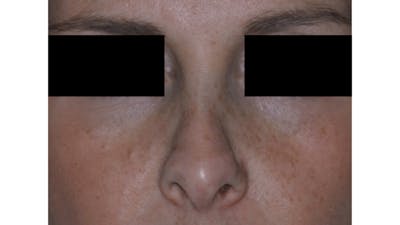 Revision Rhinoplasty Before & After Gallery - Patient 219587 - Image 1