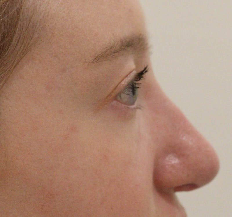 Rhinoplasty Before & After Gallery - Patient 145441 - Image 4