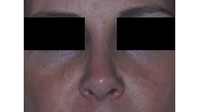 Revision Rhinoplasty Before & After Gallery - Patient 219587 - Image 2