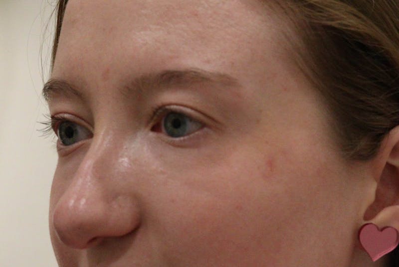Rhinoplasty Before & After Gallery - Patient 145441 - Image 5