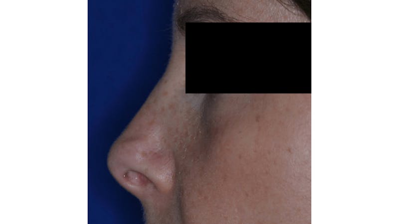 Revision Rhinoplasty Before & After Gallery - Patient 219587 - Image 3
