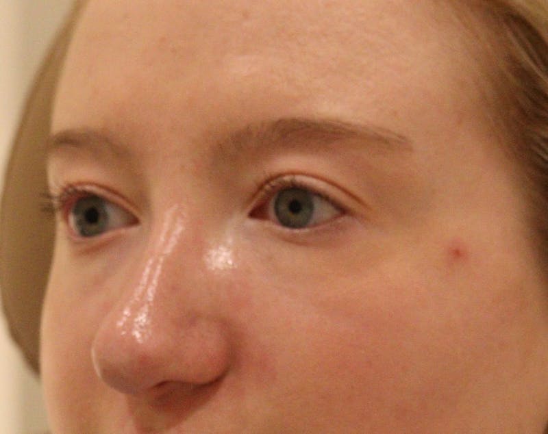 Rhinoplasty Before & After Gallery - Patient 145441 - Image 6