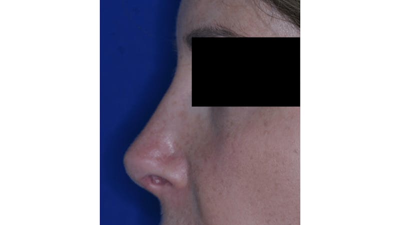 Revision Rhinoplasty Before & After Gallery - Patient 219587 - Image 4
