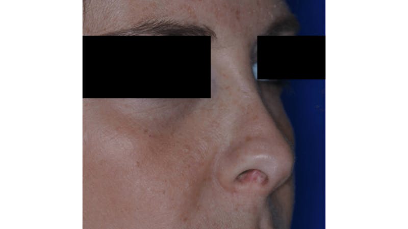 Revision Rhinoplasty Before & After Gallery - Patient 219587 - Image 5