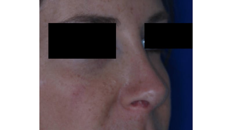 Revision Rhinoplasty Before & After Gallery - Patient 219587 - Image 6