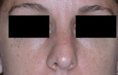 Nasal Fracture Before & After Gallery - Patient 331178 - Image 1