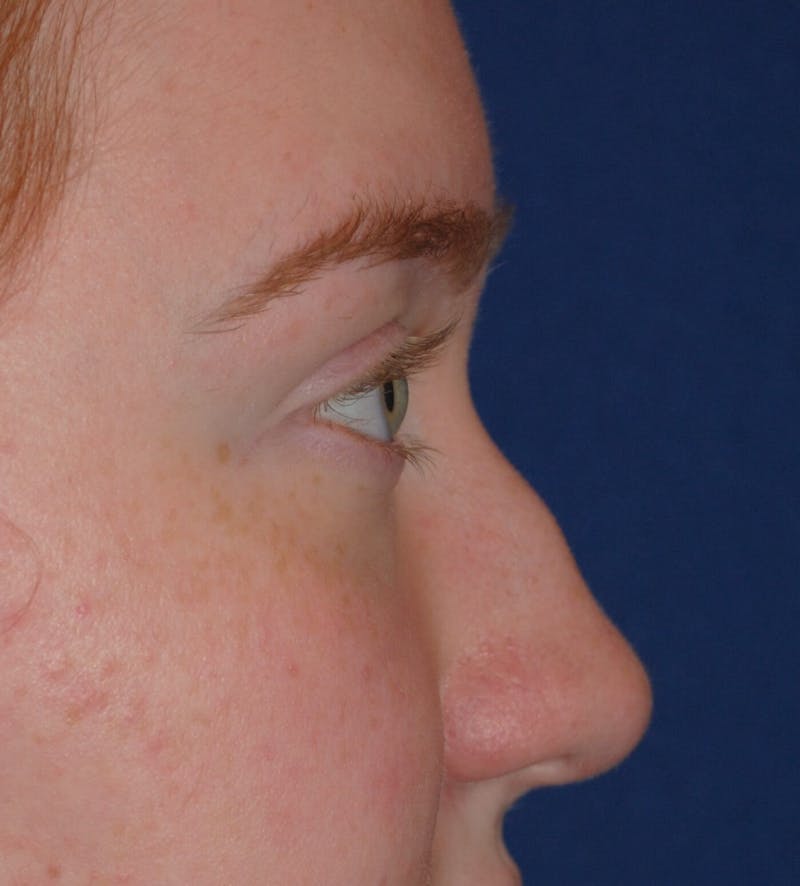 Deviated Septum Repair Before & After Gallery - Patient 405991 - Image 1