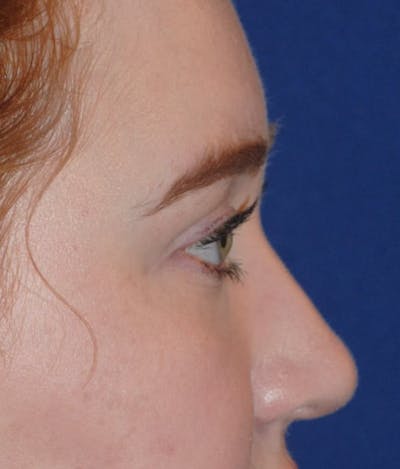 Deviated Septum Repair Before & After Gallery - Patient 405991 - Image 2