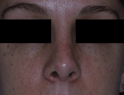 Nasal Fracture Before & After Gallery - Patient 331178 - Image 2