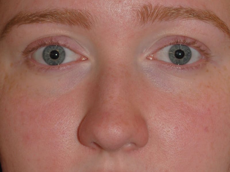 Deviated Septum Repair Before & After Gallery - Patient 405991 - Image 3