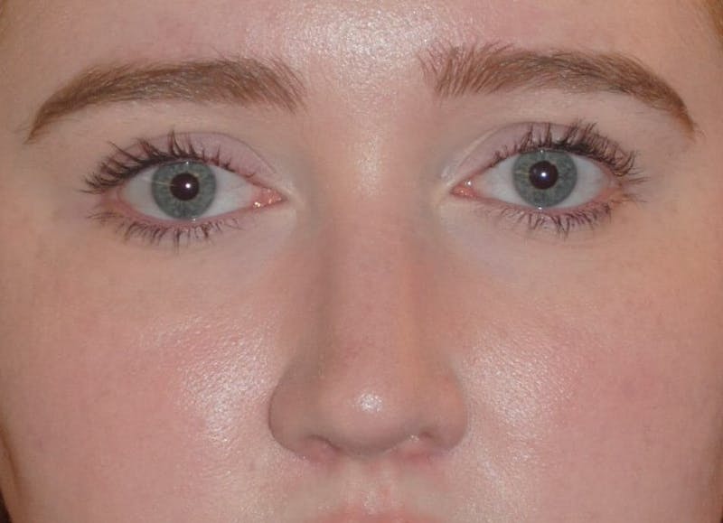 Deviated Septum Repair Before & After Gallery - Patient 405991 - Image 4