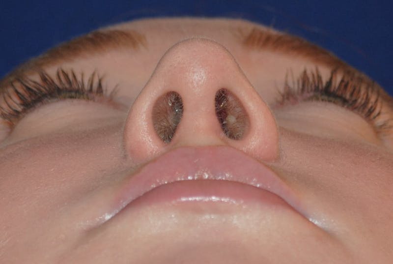 Deviated Septum Repair Before & After Gallery - Patient 405991 - Image 6