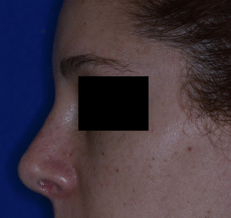 Nasal Fracture Before & After Gallery - Patient 331178 - Image 4