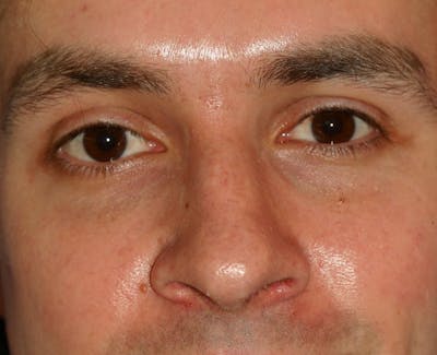 Nasal Valve Collapse Treatment Before & After Gallery - Patient 391183 - Image 2