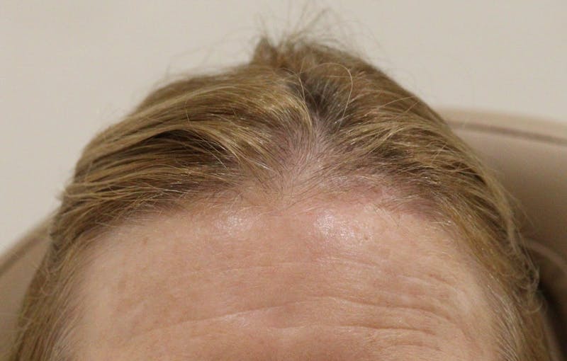 Mohs Surgery Before & After Gallery - Patient 229518 - Image 2