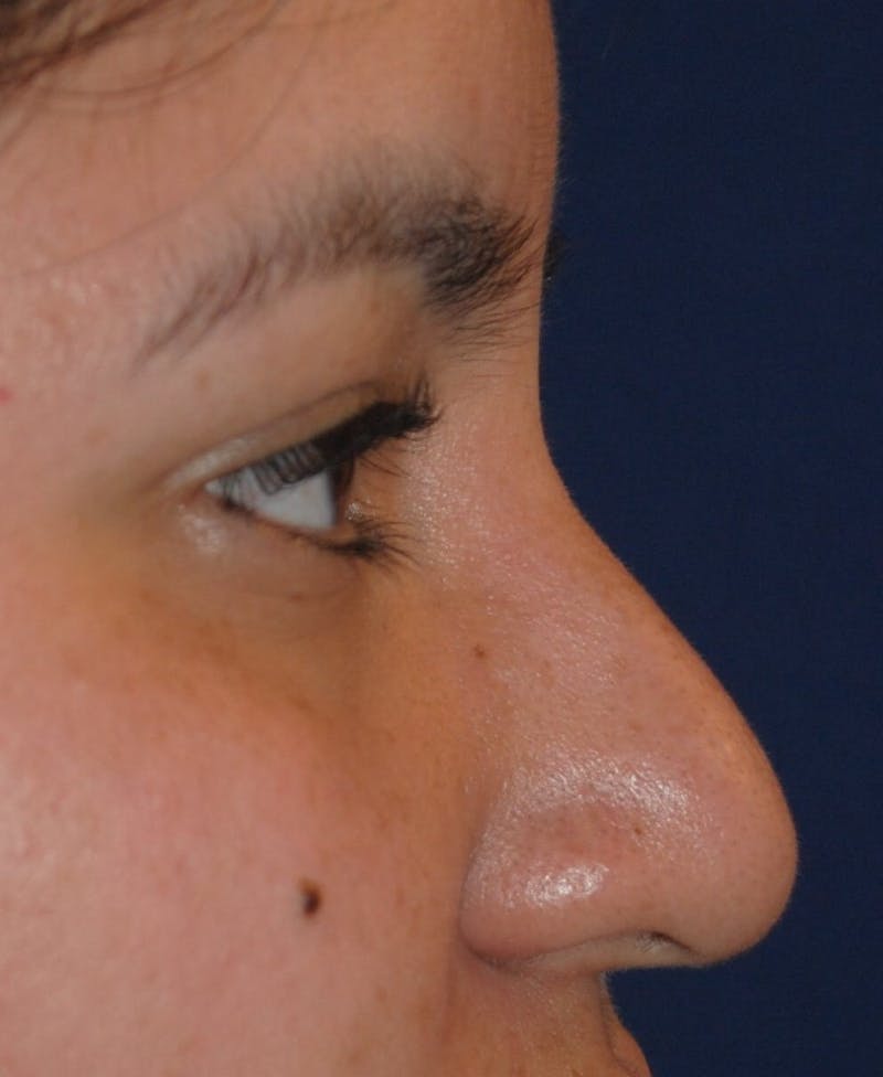 Nasal Valve Collapse Treatment Before & After Gallery - Patient 200263 - Image 3