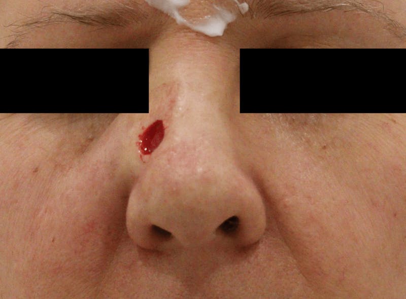 Mohs Surgery Before & After Gallery - Patient 298013 - Image 1