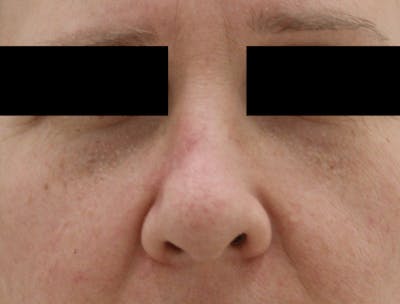 Mohs Surgery Before & After Gallery - Patient 298013 - Image 2