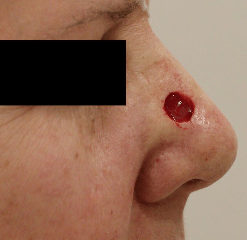 Mohs Surgery Before & After Gallery - Patient 298013 - Image 3