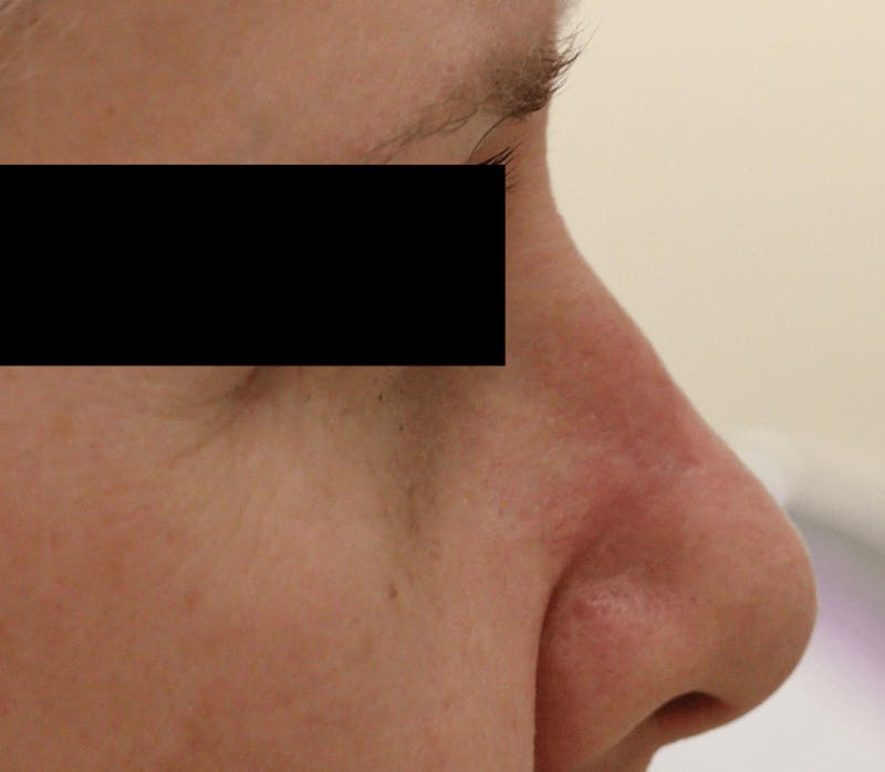 Mohs Surgery Before & After Gallery - Patient 298013 - Image 4