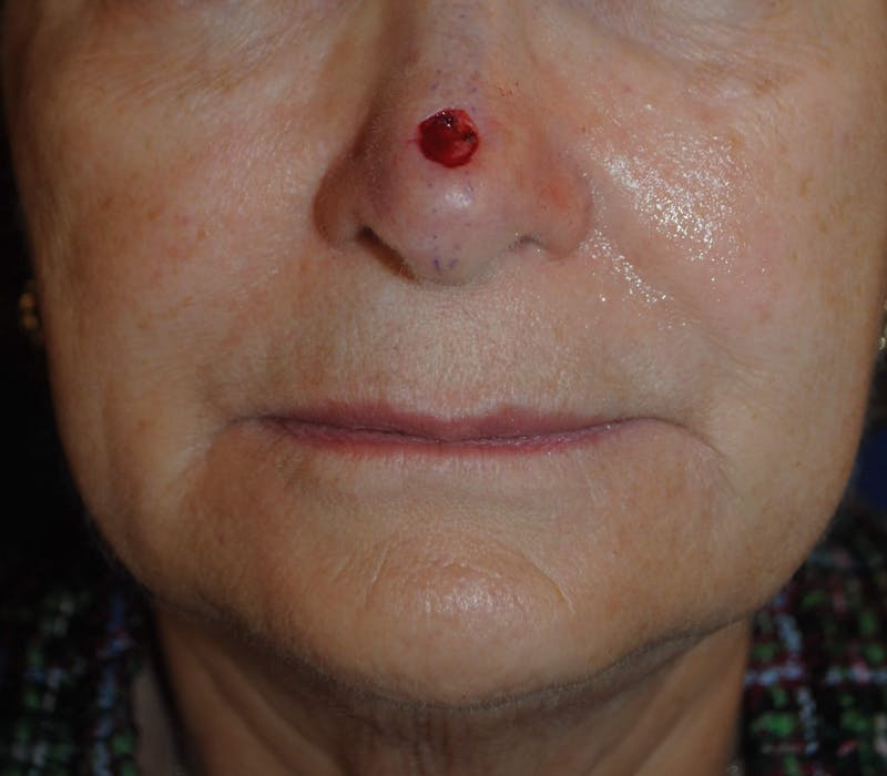Mohs Surgery Before & After Gallery - Patient 504927 - Image 1