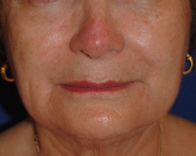 Mohs Surgery Before & After Gallery - Patient 504927 - Image 2