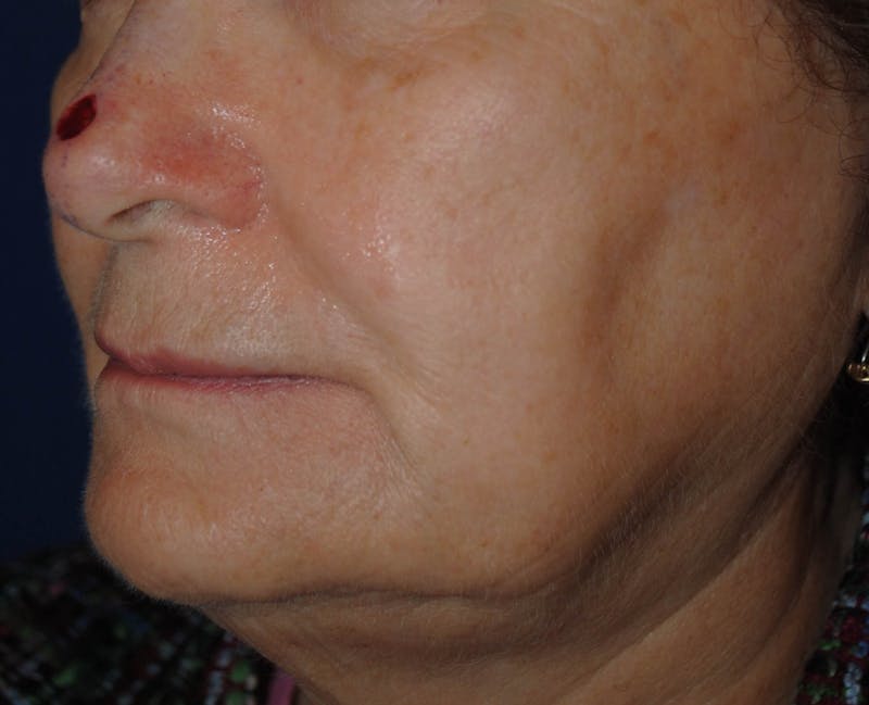 Mohs Surgery Before & After Gallery - Patient 504927 - Image 3