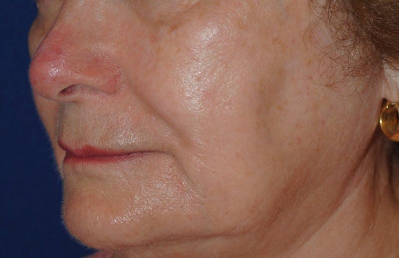 Mohs Surgery Before & After Gallery - Patient 504927 - Image 4