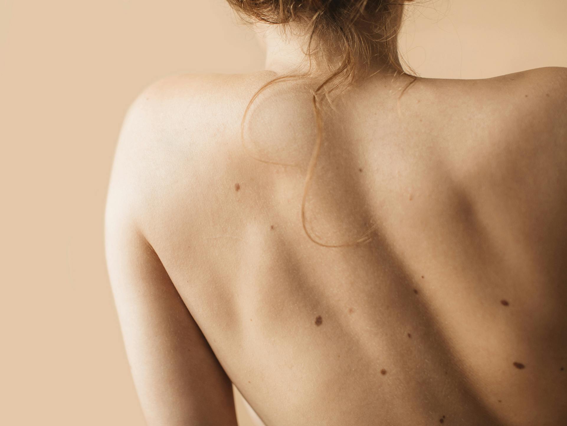 a woman's back with moles