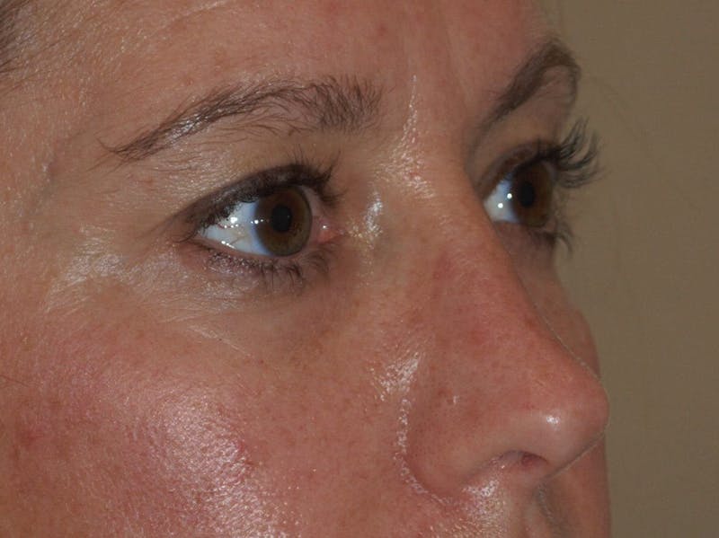 Nasal Valve Collapse Treatment Before & After Gallery - Patient 286166 - Image 3