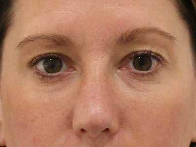 Nasal Valve Collapse Treatment Before & After Gallery - Patient 286166 - Image 2