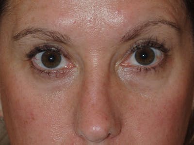 Nasal Valve Collapse Treatment Before & After Gallery - Patient 286166 - Image 1