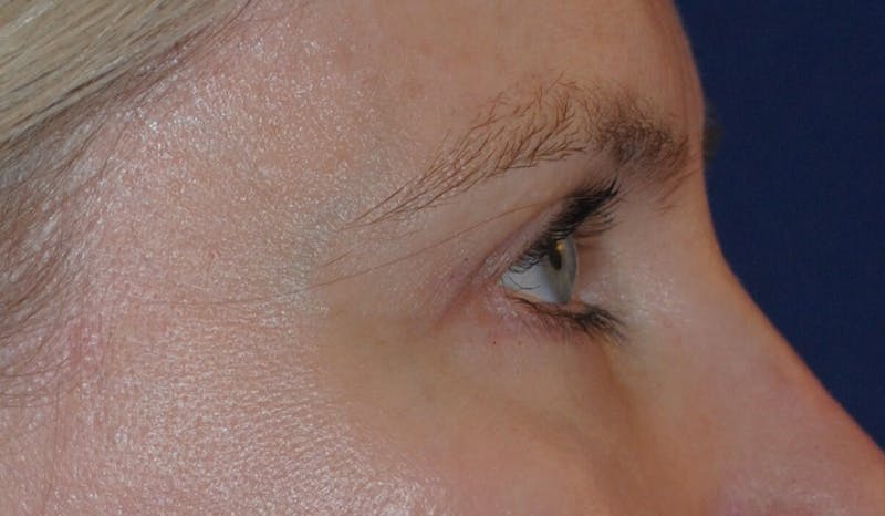 Eyelid Surgery Before & After Gallery - Patient 142403 - Image 4