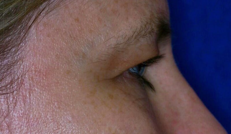 Eyelid Surgery Before & After Gallery - Patient 142403 - Image 3
