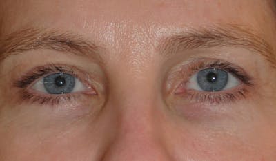 Eyelid Surgery Before & After Gallery - Patient 142403 - Image 2